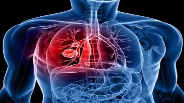 اكتشاف علاج يقلل من خطر الوفاة بسرطان الرئة