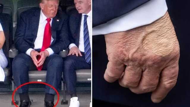 علامات على جسد ترامب تكشف مرضاً خطيراً يهدد أطرافه بالبتر ..صور