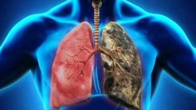 أعراض الانسداد الرئوي المزمن وطرق تشخيصه