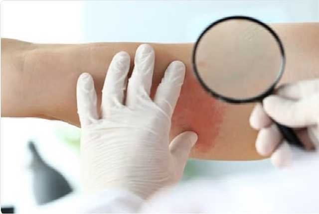 استشاري يوضح أعراض وعلاج الحزام الناري والفئات الأكثر إصابة