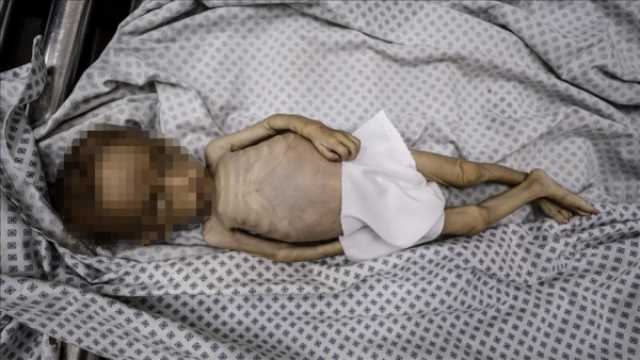 ارتفاع ضحايا التجويع في غزة إلى 193 شخصاّ بينهم أطفال
