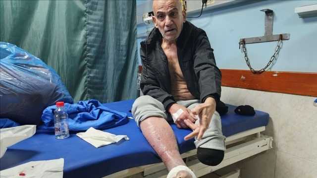 محنة مبتوري الأطراف في غزة.. آلاف يحتاجون إلى علاج ورعاية خاصة