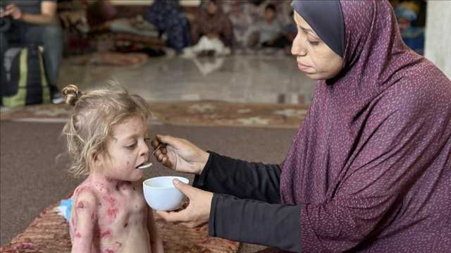 المرض ينهش جسد الطفلة نور على وقع القتل والمجاعة في غزة