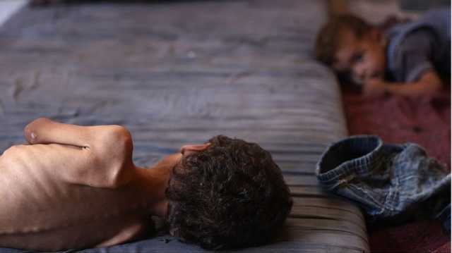 شهادة صادمة من جراح بريطاني في غزة.. أطفال يهزلون حتى الموت