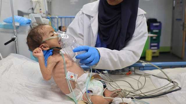 مستشفى الشفاء يعلن وفاة 21 طفلا خلال ساعات جراء المجاعة في غزة