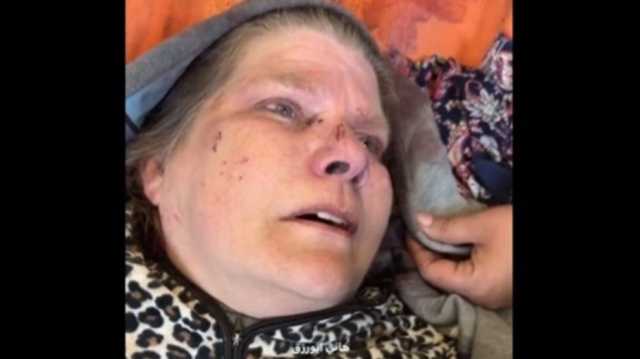 أمريكية بعد إصابتها بقصف للاحتلال على دير البلح: لن أترك لهم غزة (شاهد)
