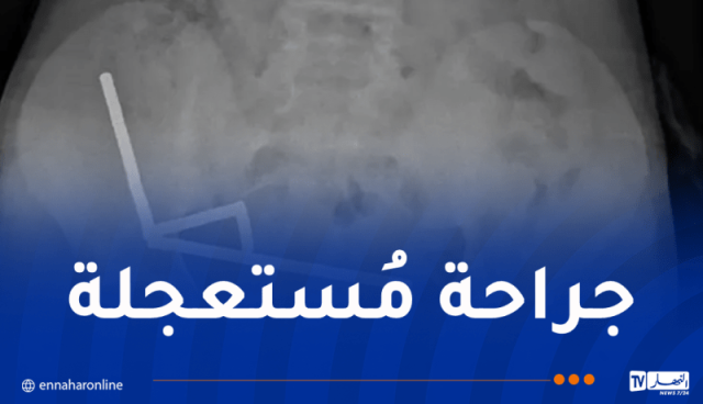 صبي يبتلع 100 مغناطيس!!