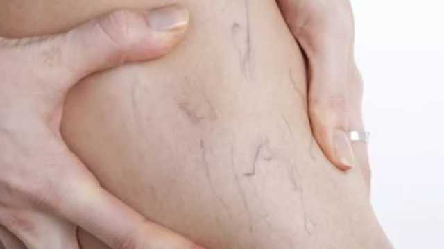 مرض خطير يصيب 40 %؜ من سكان العالم.. تعرف على أسبابه وأعراضه مرأة
