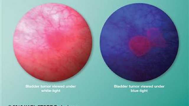 أكثر من 80 بالمئة من المشاركين تماثلوا للشفاء.. تجربة سريرية تكشف علاجًا واعدًا لسرطان المثانة