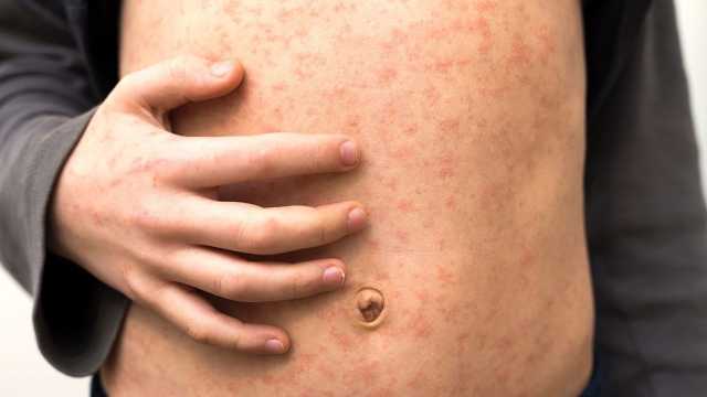 كندا تفقد صفة الخلو من الحصبة بعد نحو 30 عاما