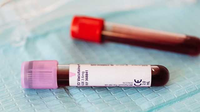 إثيوبيا تؤكد وفاة 3 أشخاص بسبب فيروس ماربورغ الشبيه بإيبولا في تفشي جديد