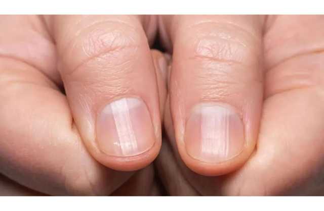الخطوط على أظافرك.. «أسرار صحية» مرتبطة بالعمر