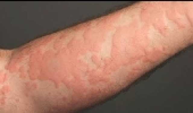 راحة طبيعية من الألم: زيوت عطرية فعالة لعلاج الصداع الأمامي دون أدوية