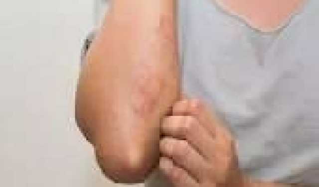 تعرف على أسباب الشعور بالبرد باستمرار، ومتى تستشير الطبيب