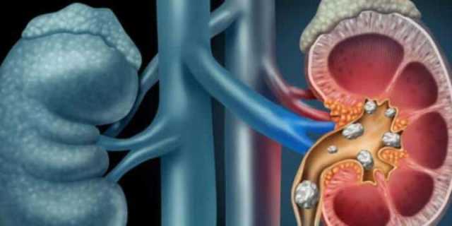 صحتك بالدنيا.. 5 طرق طبيعية للتخلص من حصوات الكلى