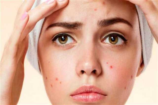 8 نصائح فعّالة لمنع الحبوب والتجاعيد على بشرتك