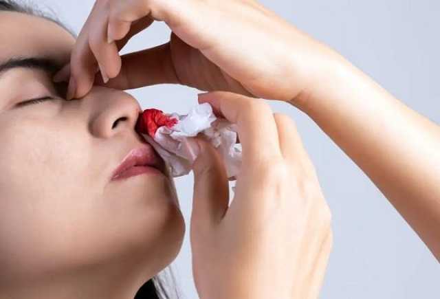 أسباب و4 نصائح مهمة.. كيف تتعامل مع نزيف الأنف؟