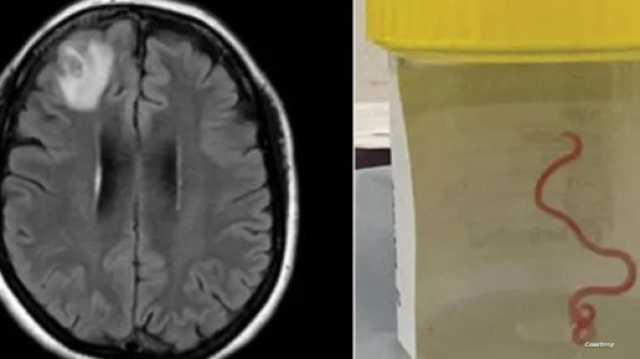 دودة الثعابين في دماغ امرأة.. حالة نادرة يكتشفها الأطباء