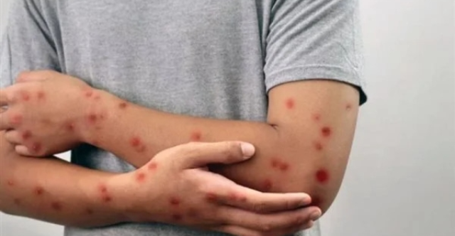 الحصبة تصل ولاية أمريكية جديدة وتهدد 8 ملايين نسمة