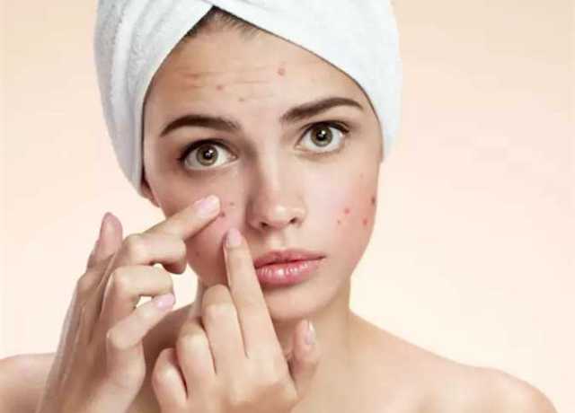طرق طبيعية للتخلص من البثور بأسرع ما يمكن