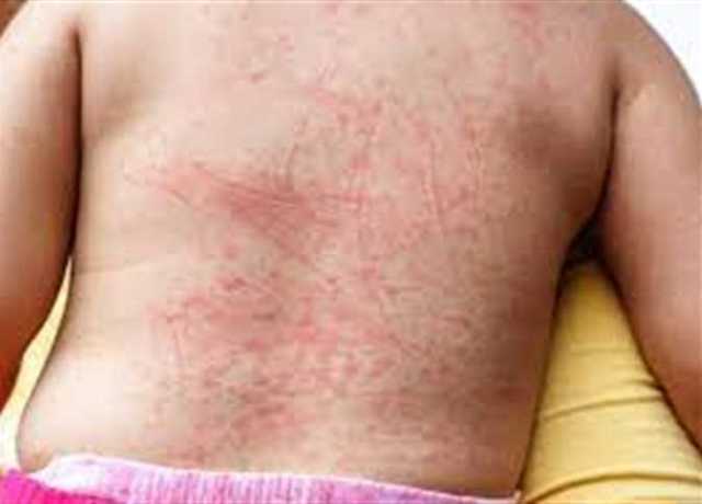 أعراض فيروس حمى الضنك وعلاجه والوقاية منه وكيفية التعامل معه