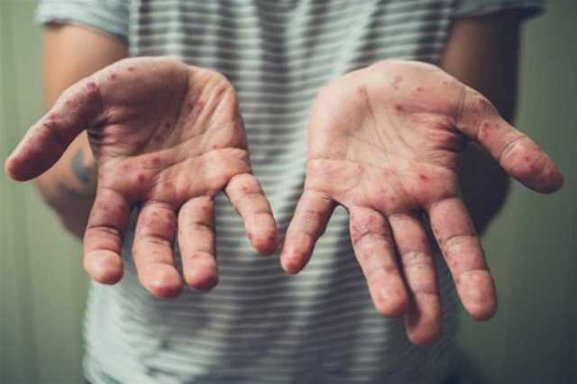 الصين تعتزم تطبيق نفس إجراءات كورونا لاحتواء تفشي جدري القردة