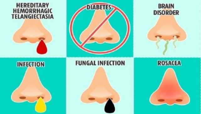 أنفك يمكن أن يكون مؤشرا على حالتك الصحية