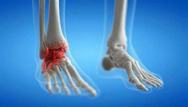 تعرف على أهم عوامل التهاب المفاصل