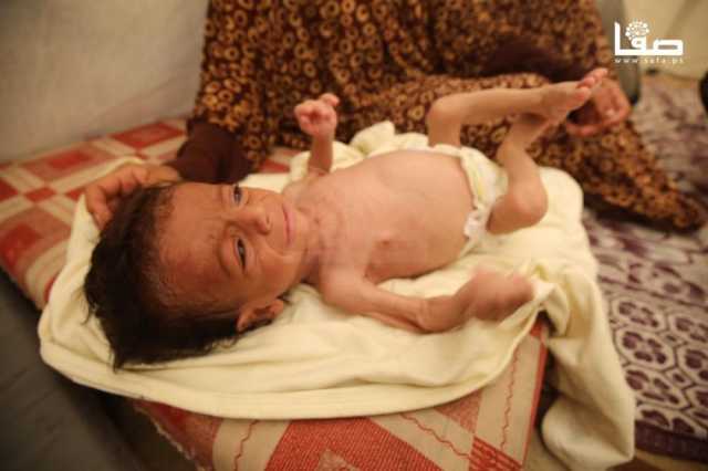 المجاعة تشتّد بغزة.. أطفال تحولوا لـ'هياكل عظمية' وسط صرخات لا تنقطع