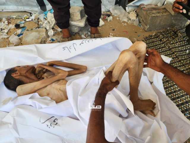 'الصحة بغزة': حالتا وفاة جديدتان جراء المجاعة ترفعان الحصيلة إلى 159 شهيدًا