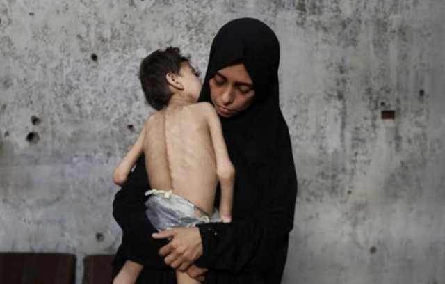 الصحة العالمية: سوء التغذية يسلك مسارًا خطيرًا في غزة