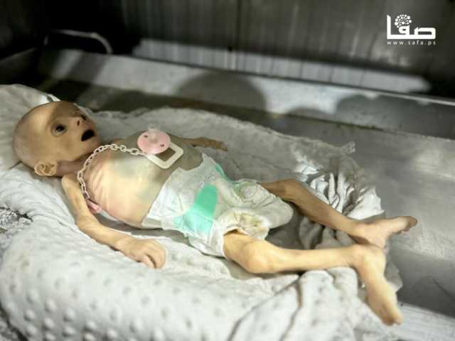 الصحة: 14 حالة وفاة جديدة بغزة بسبب المجاعة وسوء التغذية يرفع العدد لـ147