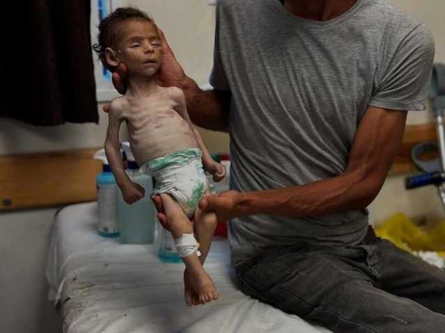 الصحة بغزة: 9 وفيات جديدة بسبب المجاعة وسوء التغذية خلال 24 ساعة