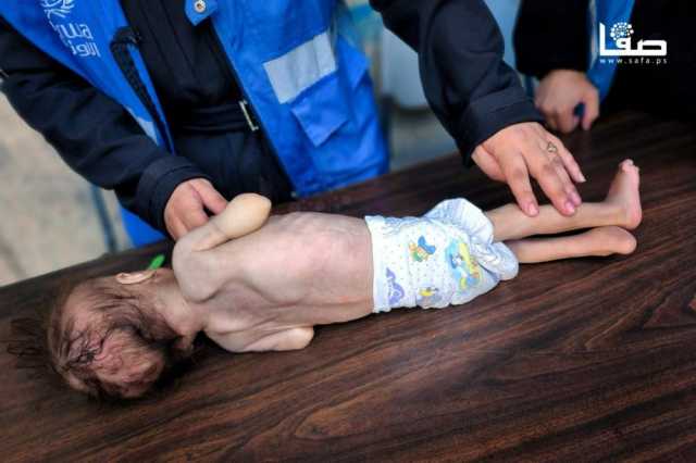 المجاعة تفتك بأطفال غزة ومخاوف حقيقية من زيادة كبيرة في الوفيات