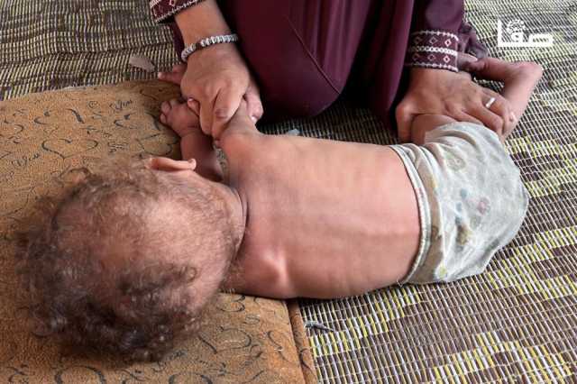 5 وفيات بغزة نتيجة الجوع وسوء التغذية خلال 24 ساعة