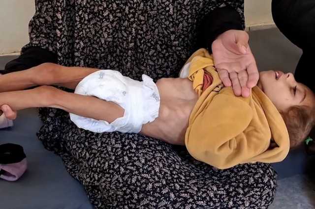 الصحة: ارتقاء 7 مواطنين بينهم طفل نتيجة سوء التغذية خلال 24 ساعة