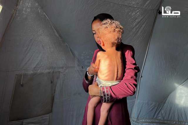 8 وفيات نتيجة الجوع وسوء التغذية بغزة خلال 24 ساعة