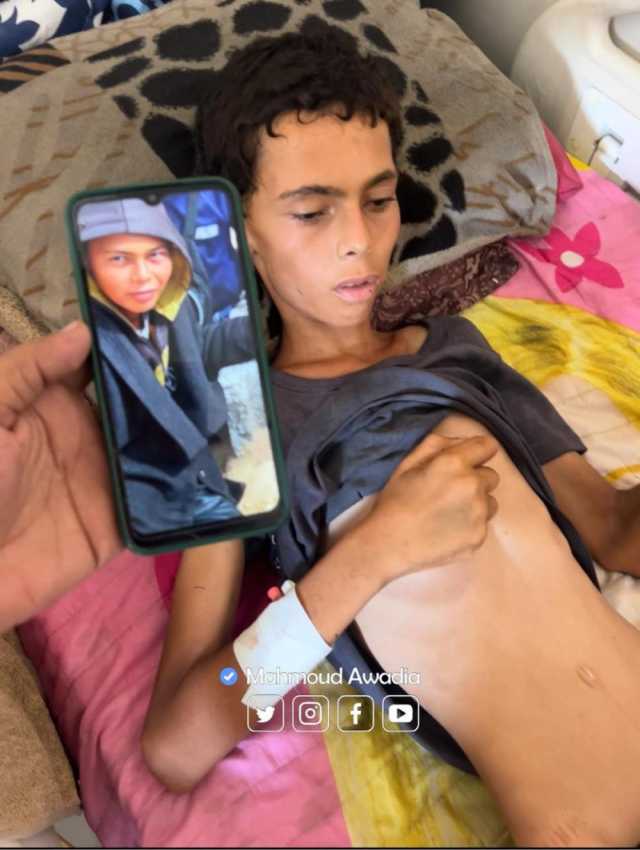 وفاة طفل في غزة نتيجة الجوع وسوء التغذية