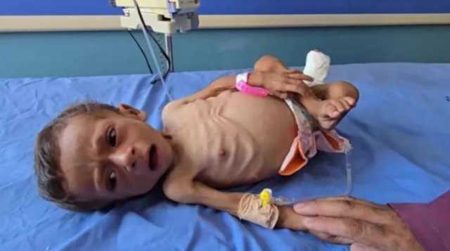 5 وفيات بغزة نتيجة المجاعة وسوء التغذية خلال 24 ساعة