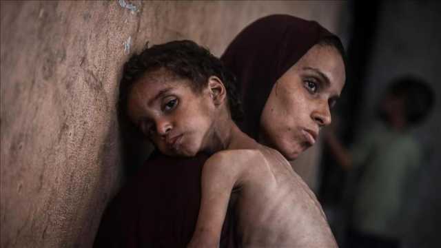 4 وفيات بغزة نتيجة الجوع وسوء التغذية خلال 24 ساعة