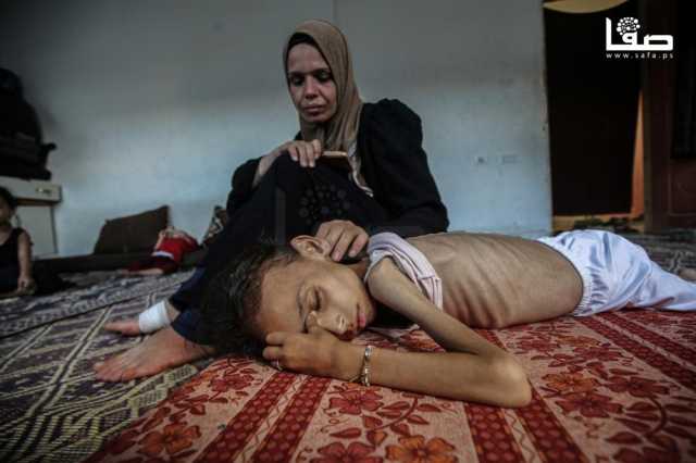 يرفع العدد لـ180.. الصحة: 5 وفيات جديدة بسبب المجاعة وسوء التغذية بغزة