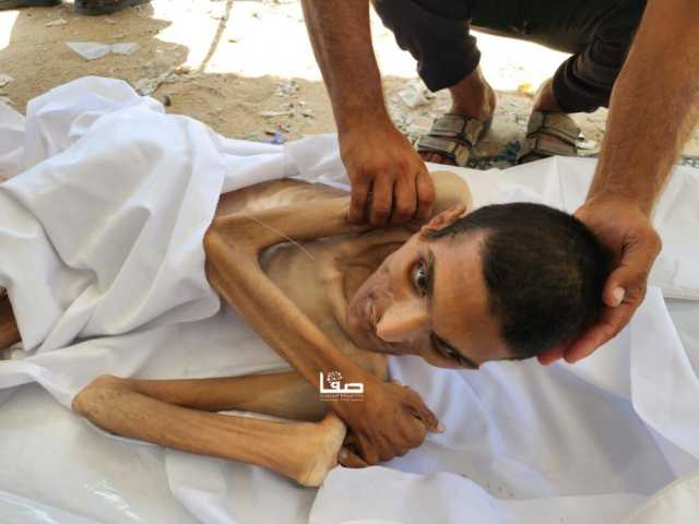 الصحة: 6 وفيات جديدة نتيجة المجاعة وسوء التغذية بغزة