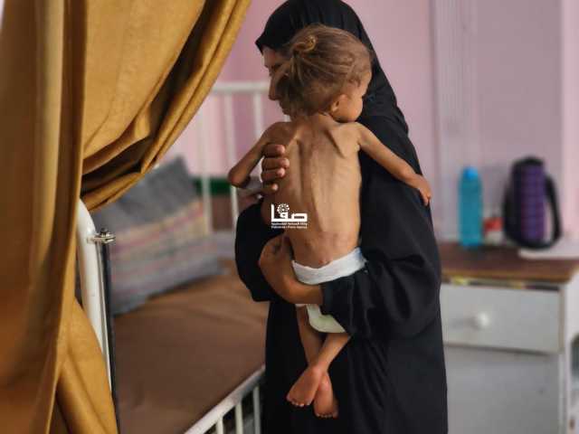 'أونروا': إصابة 508 أطفال في غزة بسوء تغذية حاد