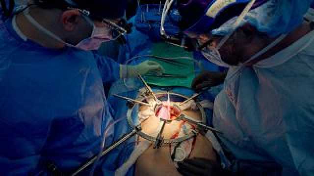 بعد 32 يوما من زرعها.. كلية خنزير تواصل العمل في جسد رجل في حالة وفاة دماغية