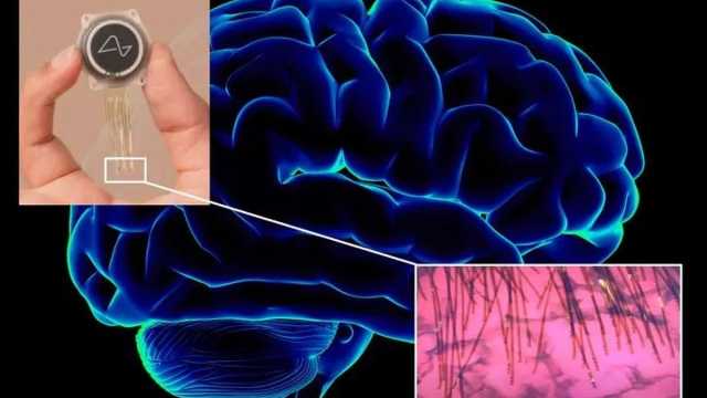 هذا ليس خيالاً علمياً.. إيلون ماسك يعلن نجاح زراعة أول شريحة في دماغ إنسان
