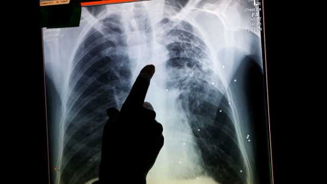 عودة قاتل قديم: لماذا يرتفع معدل الإصابة بالسل مجددًا في المملكة المتحدة؟