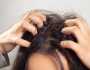 طرق طبيعية سحرية للتخلص من حكة الشعر في الطقس الحار.. وداعا للمعاناة