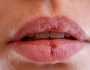 احذر.. هذه العلامات تشير إلى إصابتك بسرطان الشفاه