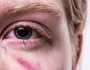 اعراض حساسية العين وطرق علاجها المختلفة