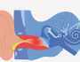 التهاب قناة الأذن.. الأسباب والأعراض